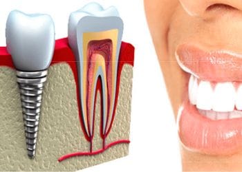 implantes-dentales-home