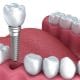 Implante Unitario en Cordoba -- Clinica dental - Odontologo