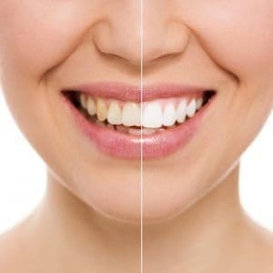 Blanquear los dientes en Córdoba