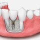 Implante de Hueso en Córodba - Odontología