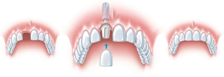 Implantes Unitarios - Centro Odontológico en Córdoba Implantes unitarios - Odontologo en Córdoba