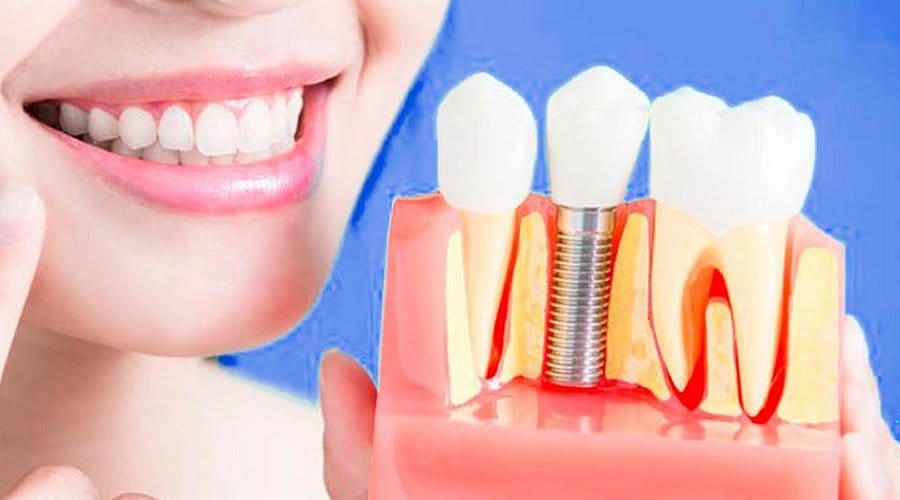 Implantes dentales en córdoba - Clinica Dental - Precio y cuotas