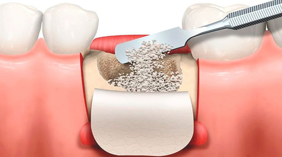 Injerto óseo dental en Córdoba Injerto de Hueso - Clinica dental Córdoba