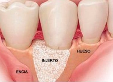 Injerto de Hueso dental - Consultorio Doc Oral Implante de Hueso en Córdoba - Odontología