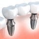 Tratamiento implante dental Cordoba - Odontólogo