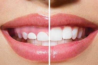 Alagamiento de Corona en Córdoba - Clinica dental - Tratamiento
