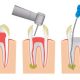Tratamiento de conducto - DocOral - Dentistas en Córdoba