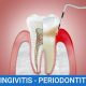 Periodoncia: Gingivitis Periodontitis Tratamiento odontologo Córdoba