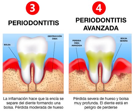 Odontología en Córdoba: Periodontitis Sintomas Tratamiento